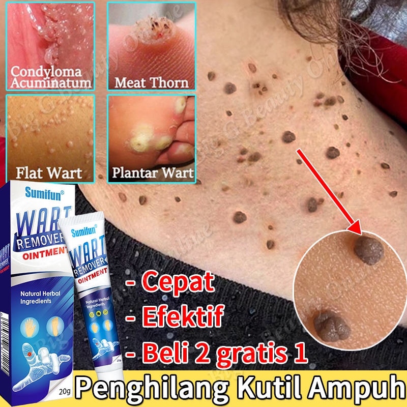 Krim Penghilang Kutil Dan Tahi Lalat Obat Kutil Di Leher Salep Kutil Paling Ampuh Obat Kutil Kelamin