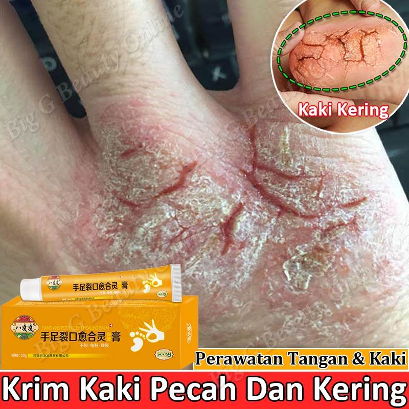 Cream Kaki Pecah Dan Kering Obat Kaki Pecah Pecah Perawatan Tangan Salep Kaki Pecah2 Paling Ampuh Kr