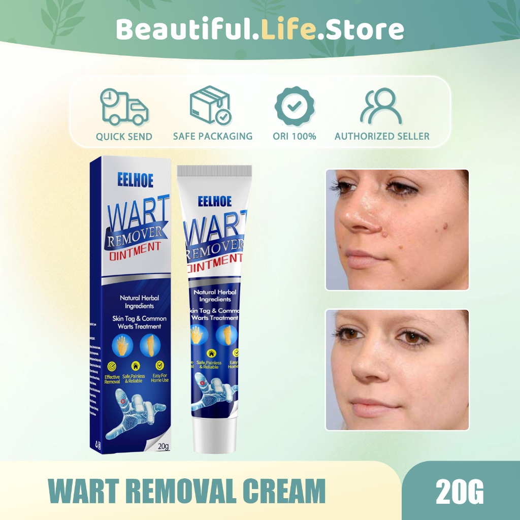 EELHOE Wart Removal Cream 20g Penghilang Kutil Wart Remover Ointment Menghilangkan Kutil