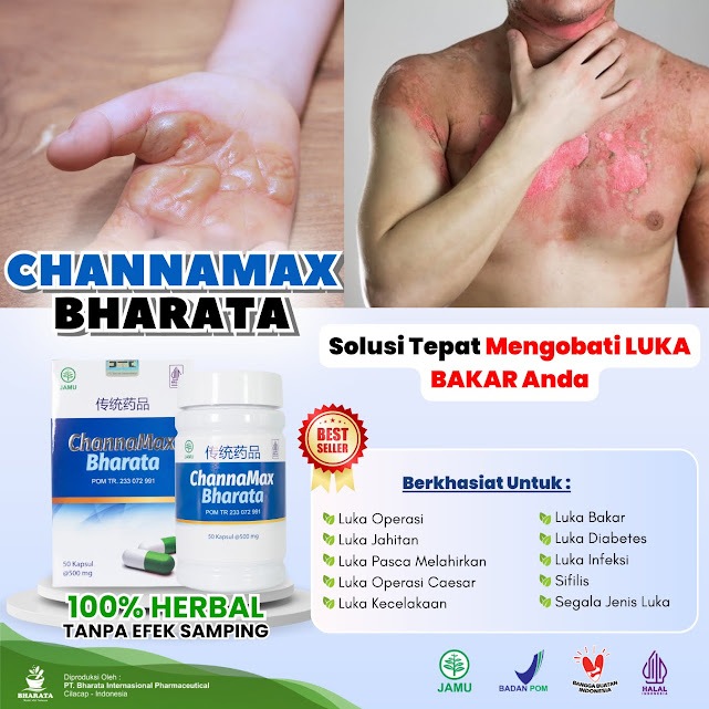 Channamax Bharata Obat Herbal Luka Diabetes | Pasca Operasi Caesar Pengobatan Luka Luar Luka Dalam