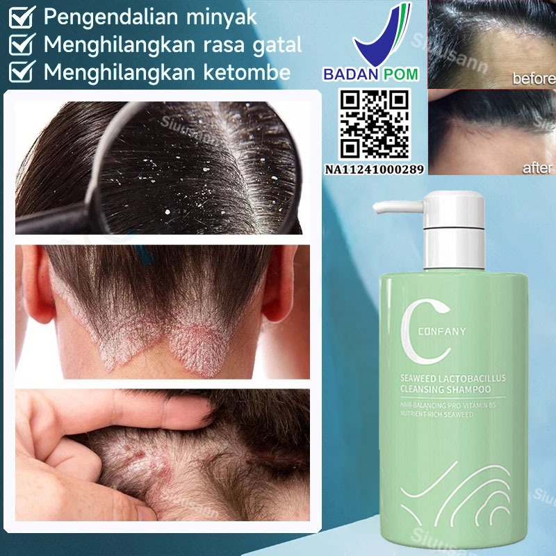 shampo anti ketombe sampo psoriasis penghilang ketombe berkerak psoriasis kulit kepala oil control a