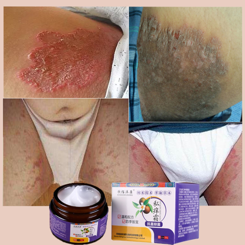 Salep gatal selangkangan Anti jamur salep Salep gatal paling ampuh Selangkangan Salep gatal pada mis