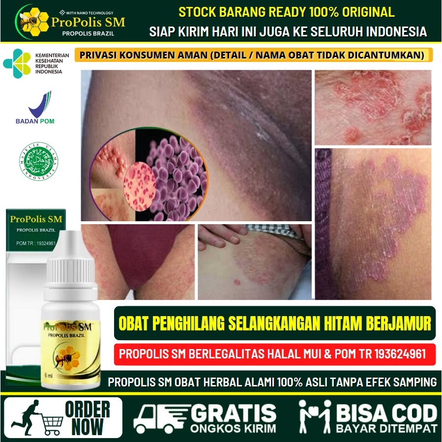 Obat Tradsional Gatal Parah di Selangkangan, Salep Penghilang Ruam Merah Gatal Kronis di Selangkanga