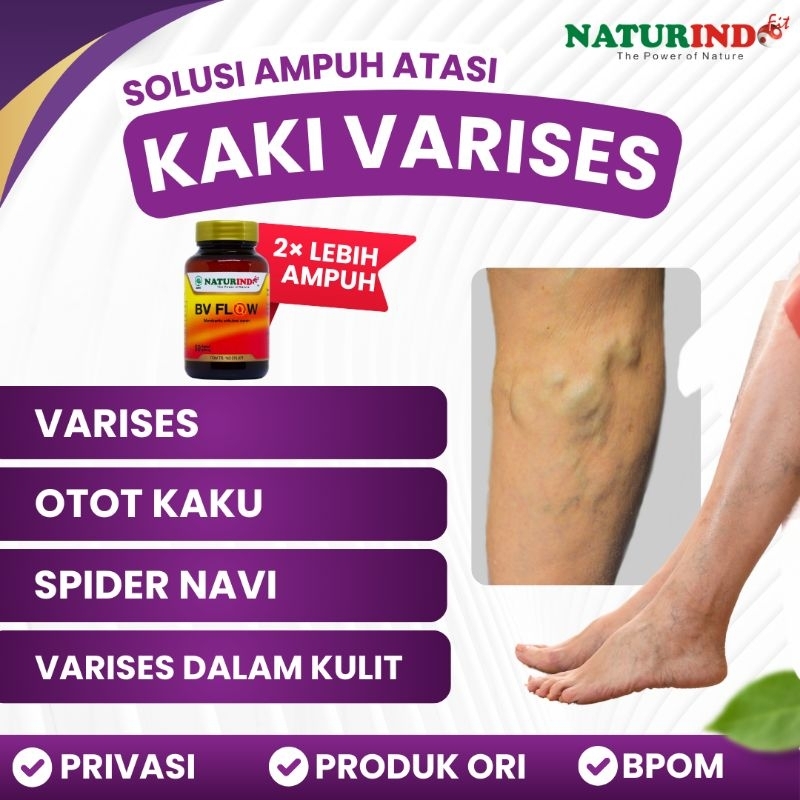 Obat Varises Otot Kaki Bengkak Naturindo Herbal