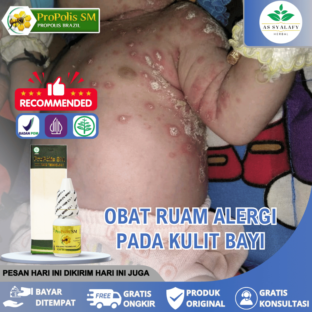 Obat Oles Ruam Pada Bayi Kulit Bayi Iritasi Gatal Gatal Merah Infeksi Kulit Yang Aman Propolis Sm
