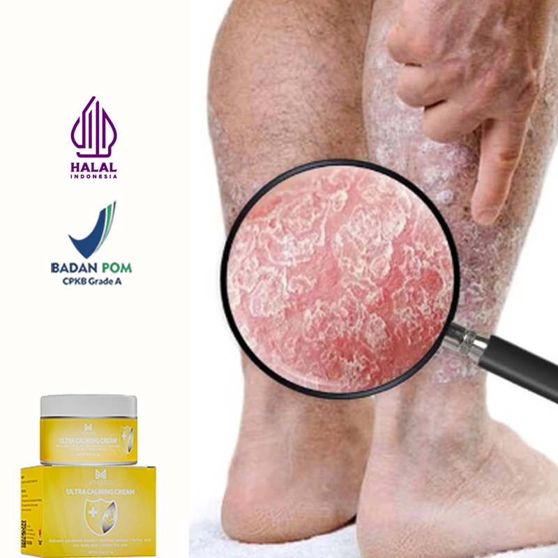 Obat gatal salep gatal selangkangan salep gatal china paling ampuh salep eksim kering paling ampuh 2