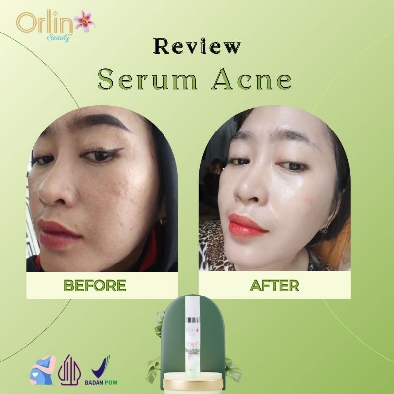 SERUM ACNE ORLIN BEAUTY
