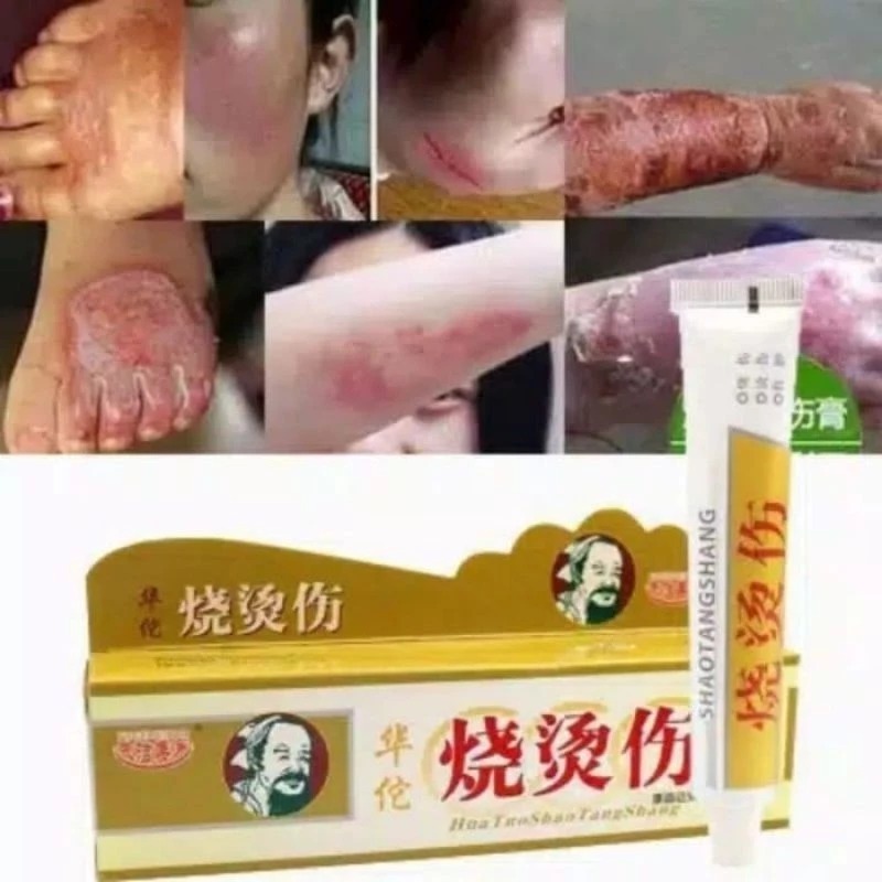 SHAOTANGSHANG Obat Luka Bakar Melepuh Salep Huatuo 100% Original Herbal Cina Keloid