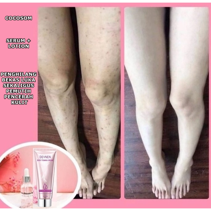 PAKET COCOSOM SERUM + LOTION PENGHILANG BEKAS LUKA KORENG BUDUKAN LAMA MENGHITAM + PEMUTIH KULIT KOR