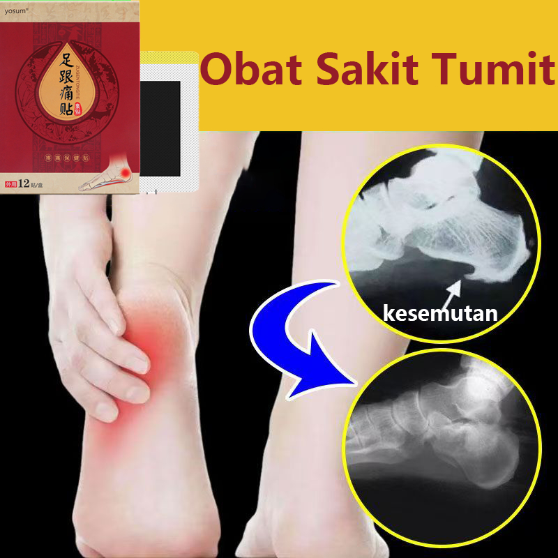 Sakit Tumit Koyo Kaki Pereda Nyeri Plantar Fasciitis Terapi Obat Sakit Kaki Obat Sakit Telapak Kaki