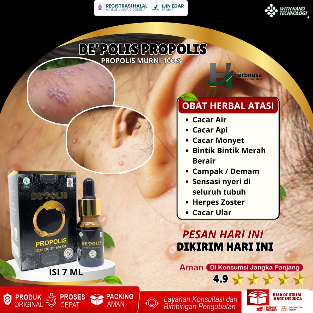 Obat Cacar Air Cacar Api Cacar Monkeypox Bintik Bintik Merah Berair Cacar Berair Campak Penghilang B
