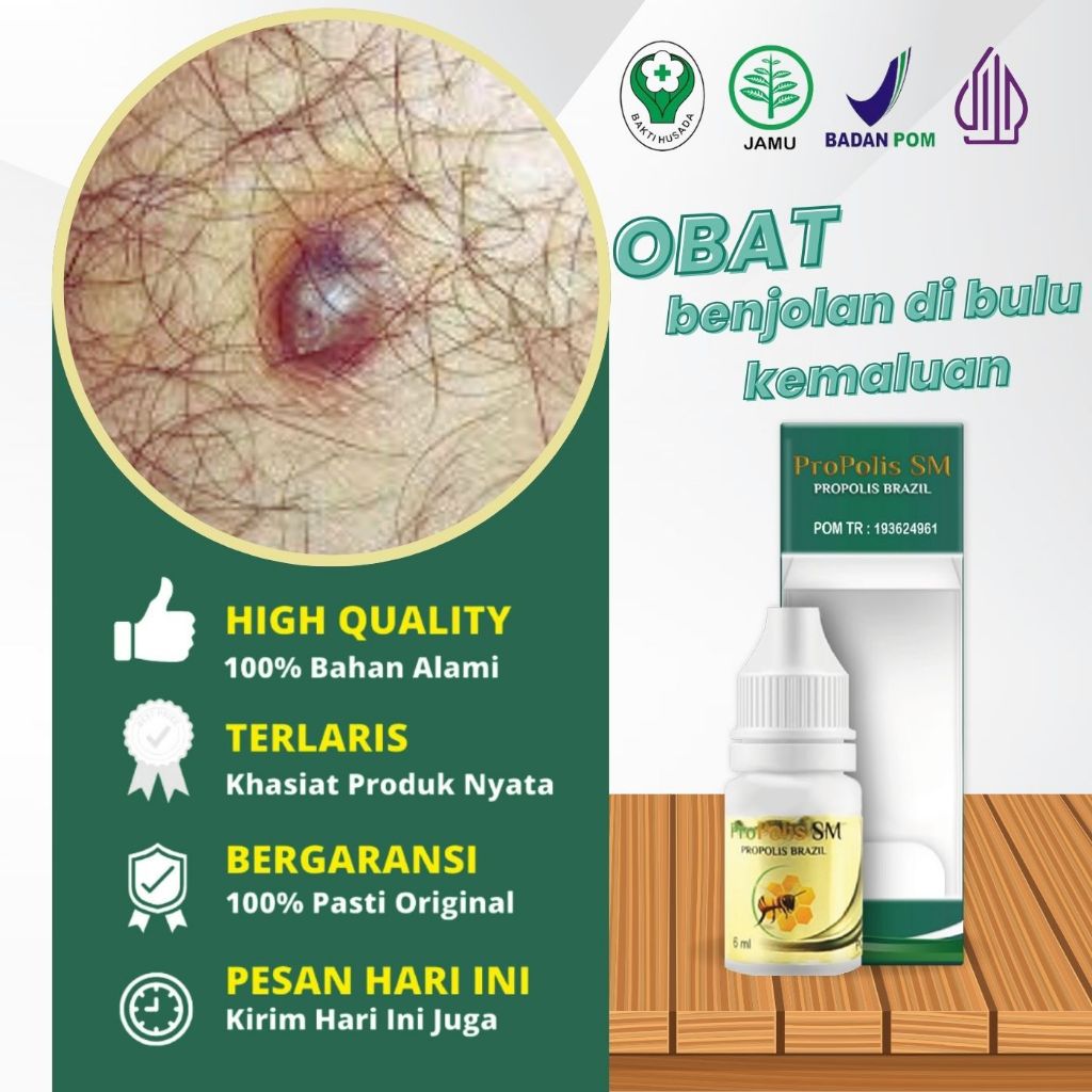 Obat Benjolan Di Bulu Kemaluan, Obat Mengempeskan Benjolan Kelamin Pria & Wanita, Obat Benjolan Bern