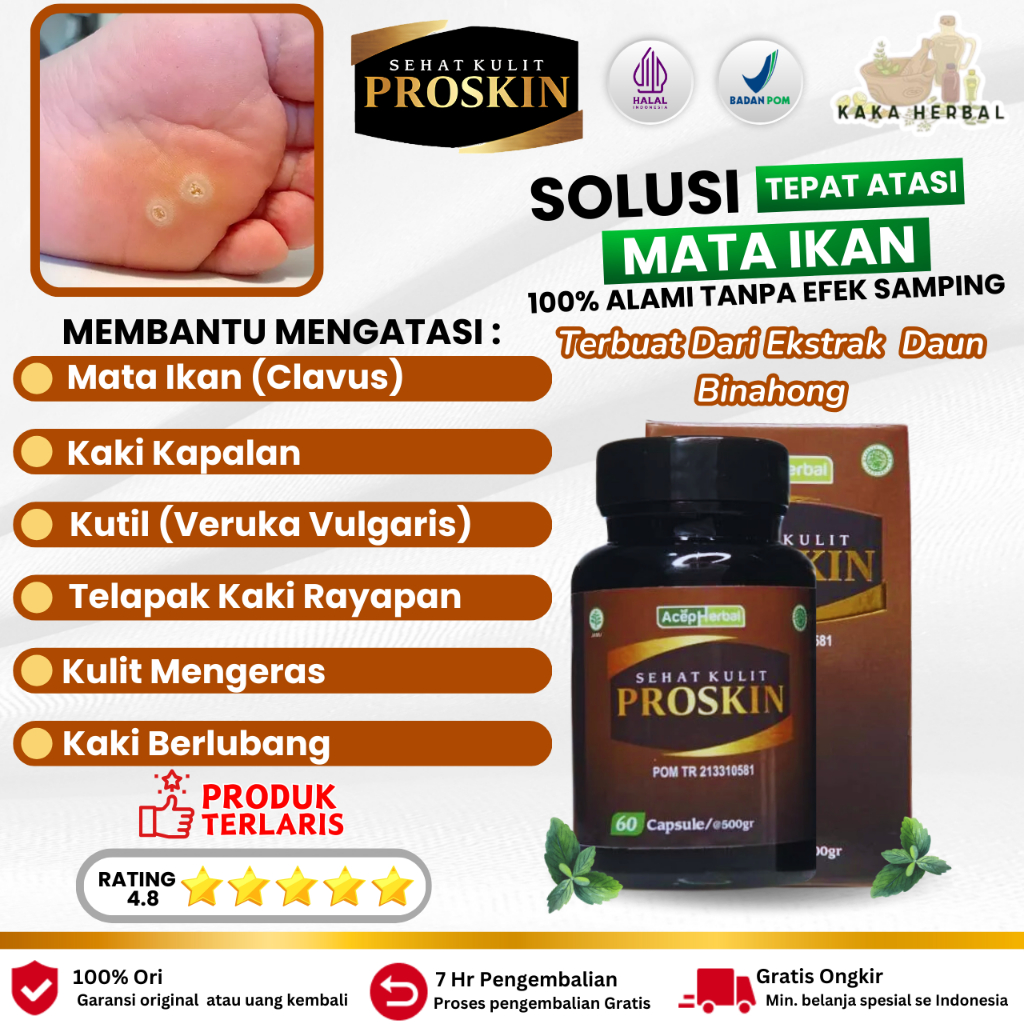 Kaka Hebal - Obat Mata Ikan, Obat Mata Ikan Di Telapak Kaki, Obat Mata Ikan Di Kaki, Obat Oles Mata 