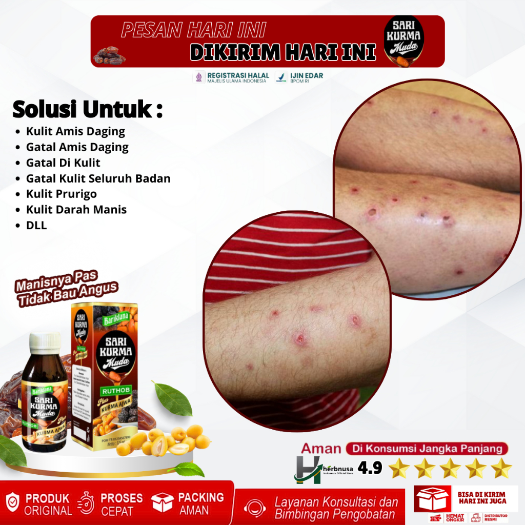 Obat Darah Manis, Obat Gatal Prurigo, Obat Amis Daging, Obat Luka Darah Manis, Obat Peradangan Pada 