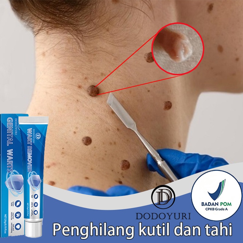 Obat kutil Penghilang kutil dan tahi lalat Obat kutil kelamin Penghilang tahi lalat 20ml Menghilangk