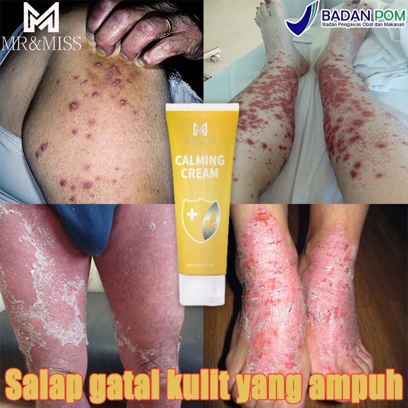 Obat gatal selangkangan Obat gatal kulit Salep gatal china paling ampuh 20ml salep china gatal palin