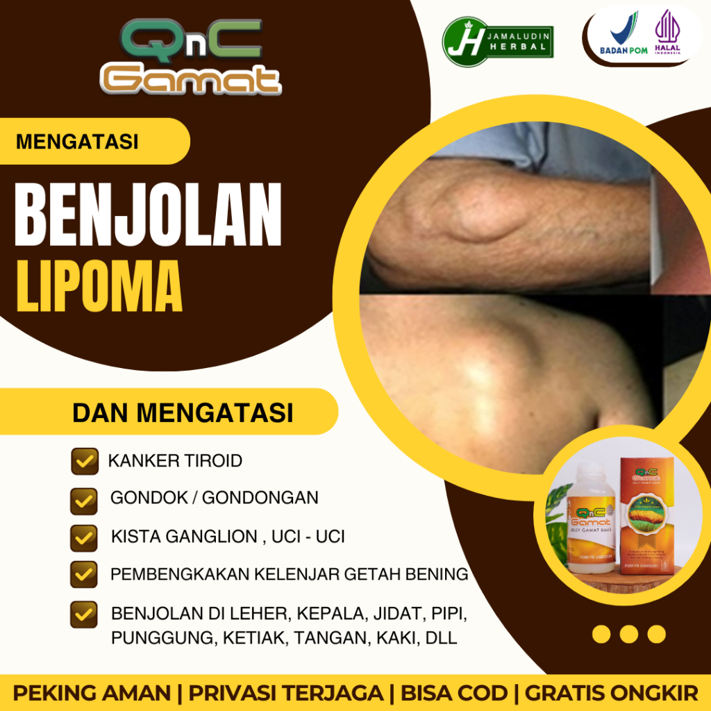 COD  Salep Penghancur Lipoma - Obat Oles Lipoma Pada Bayi, Anak, Dewasa, lansia - Apa Obat Buat Lipo