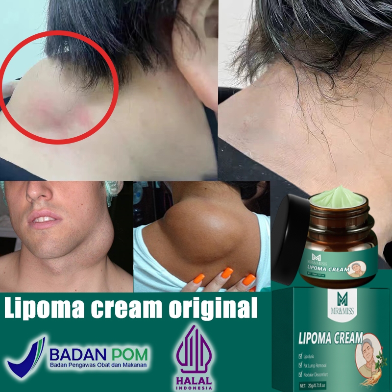 Lipoma removal cream original  Obat benjolan Lipoma cream original 20g salep benjolan lipoma lipoma 