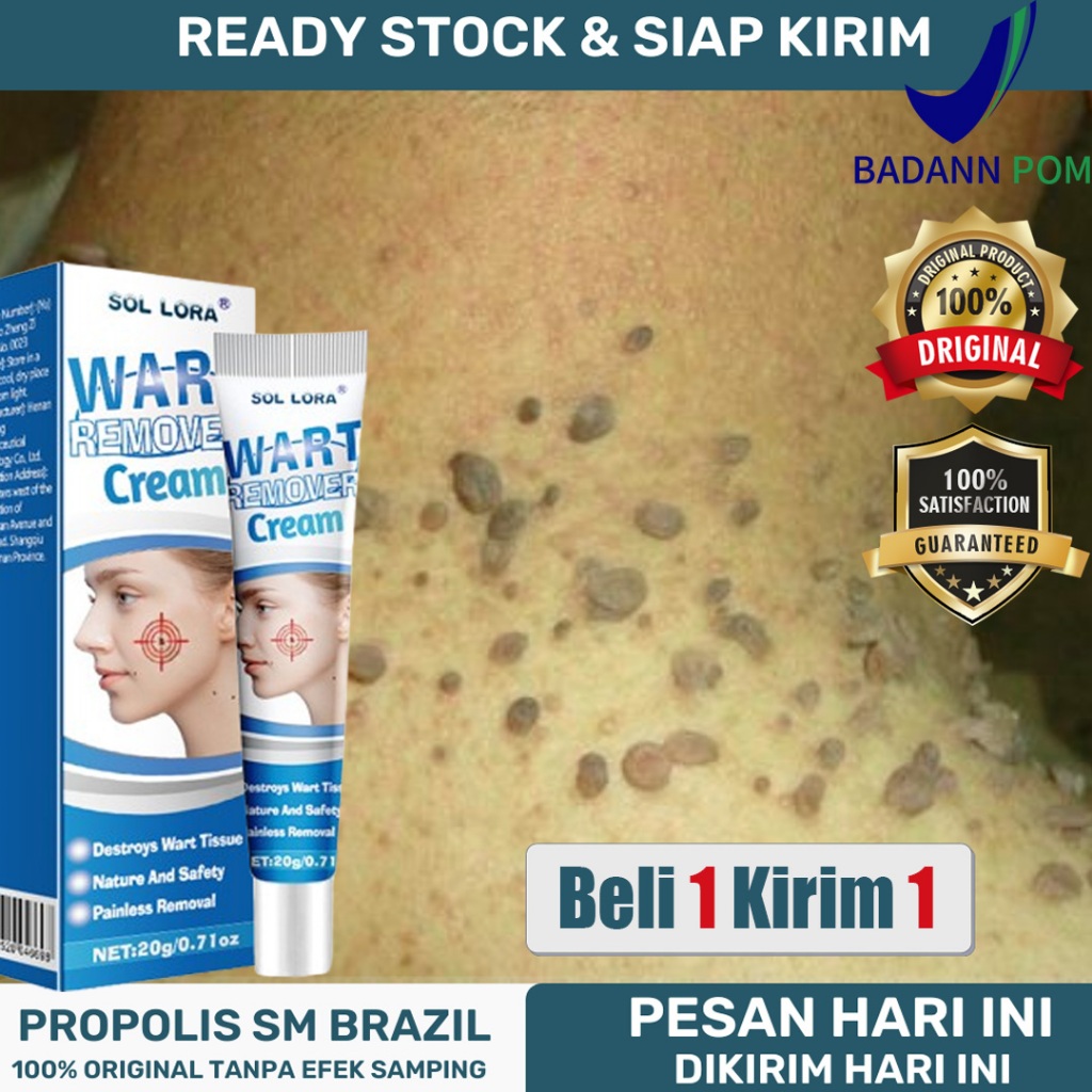 obat kutil paling ampuh oles Wart Removal Cream Krim Penghilang Lalat Obat Kutil Paling Ampuh  Kutil