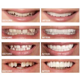 PERFET SMILE GIGI PALSU LEPASAN ( ATAS BAWAH ) 2 PASANG