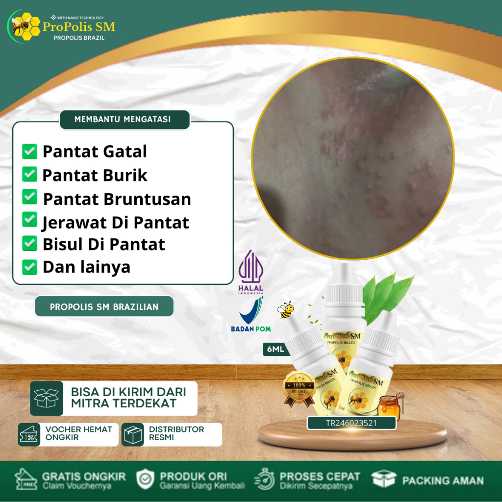 ProPolis SM - Obat Pantat Gatal dan Hitam, Obat Pantat Burik, Obat Pantat Bruntusan, Obat Jerawat Di