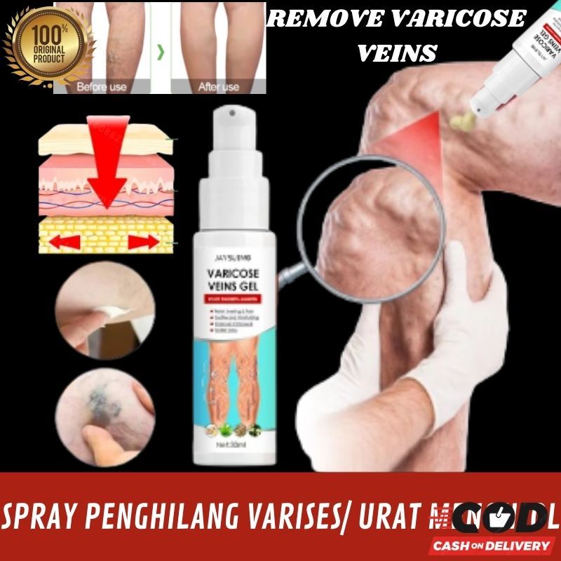 Varicose veins spray semprotan varises vena salep krim penyembuh dan penghilang varises parises angi