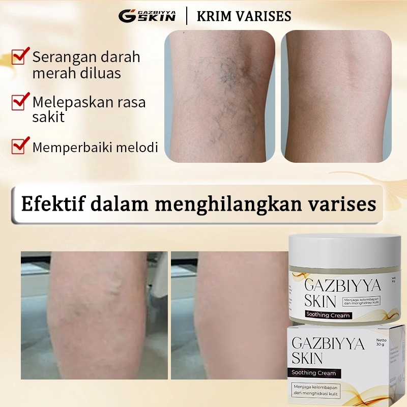 AMND Obat varises Varicose veins cream Cream varises paling ampuh original Salep varises 30g obat