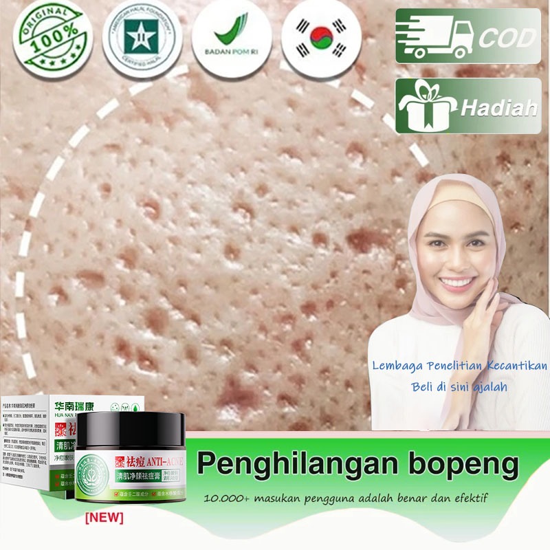Cream Perbaikan Bekas Jerawat /untuk Jerawat Parah, Jerawat Berjerawat, Bekas Jerawat, Bopeng, Pengh
