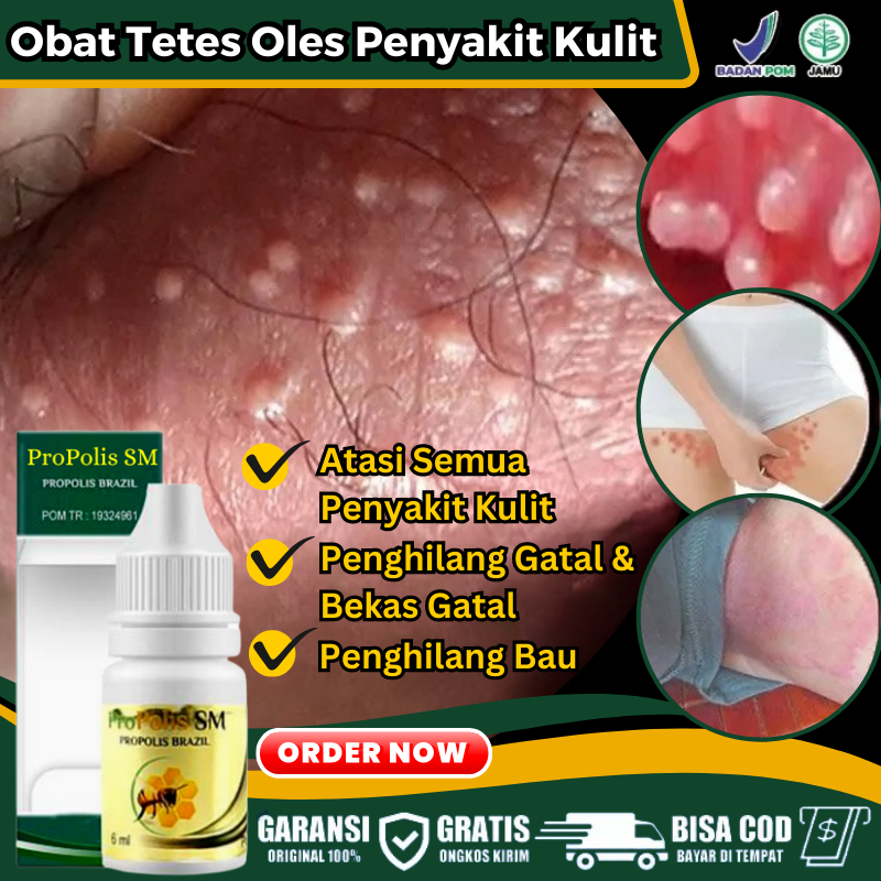 Obat Gatal di Alat Kelamin Pria & Wanita Penghilang Bentol - Bentol di Kemaluan, Obat Oles Pengempis