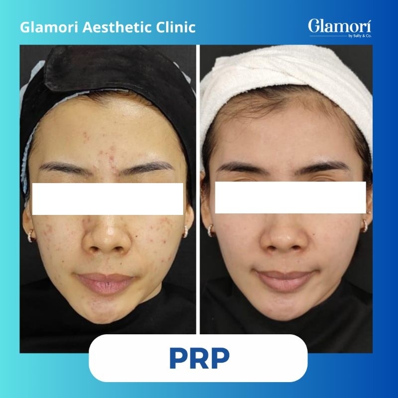 PRP "PLATELET RICH PLASMA" //PORI-PORI//SCAR/BOPENG