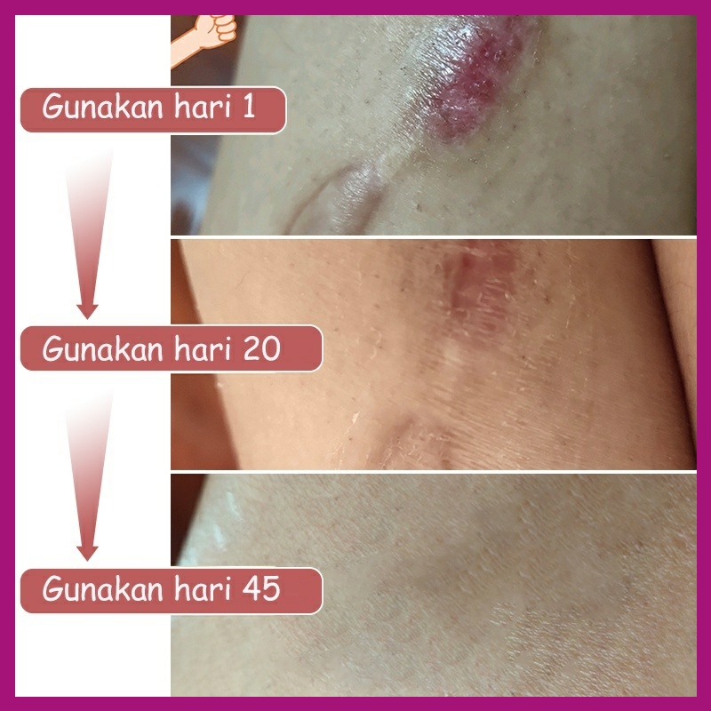 ISA Penghilang bekas luka hitam koreng salep penghilang bekas luka hitam salep keloid paling ampuh