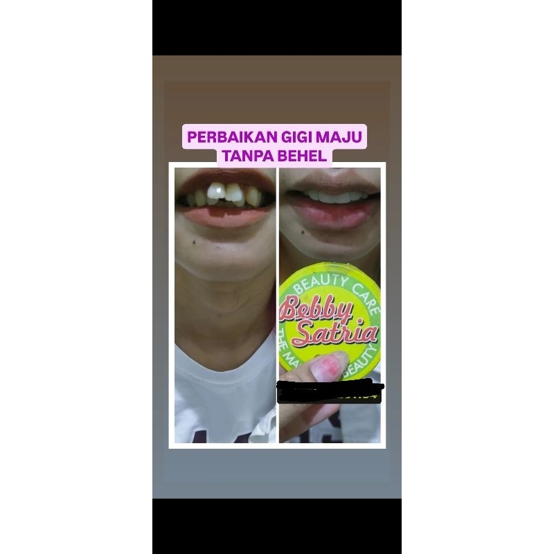 bayar DP dan diskon merapikan gigi renggang/maju tanpa behel