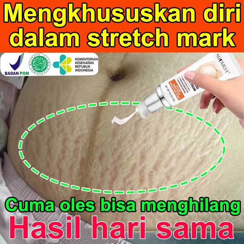 Stretch mark cream Penghilang stretch mark Cream stretch mark paling ampuh Cream penghilang stretch 