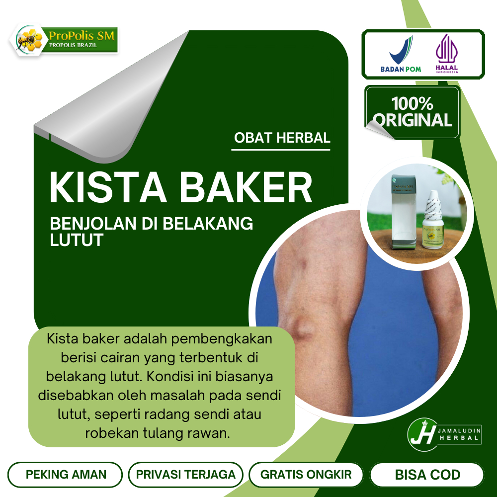 Obat Herbal Oles Penghilang Kista Baker. Benjolan Di Belakang Lutut.Mengatasi Kista Ganglion. Lipoma