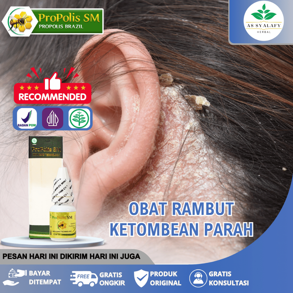 Obat Ketombe Menahun Ketombe Parah Ketombe Berkerak Yang Terlaris Propolis SM Di Surabaya