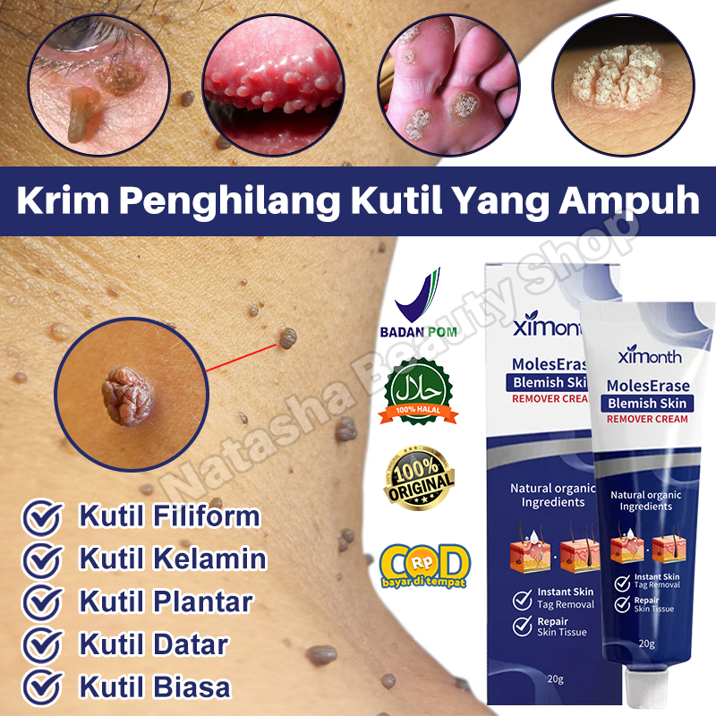 Salep Kutil Obat Penghilang kutil Ampuh Salep Penghilang Tahi Lalat 20g Salep Penghilang Kutil di Wa