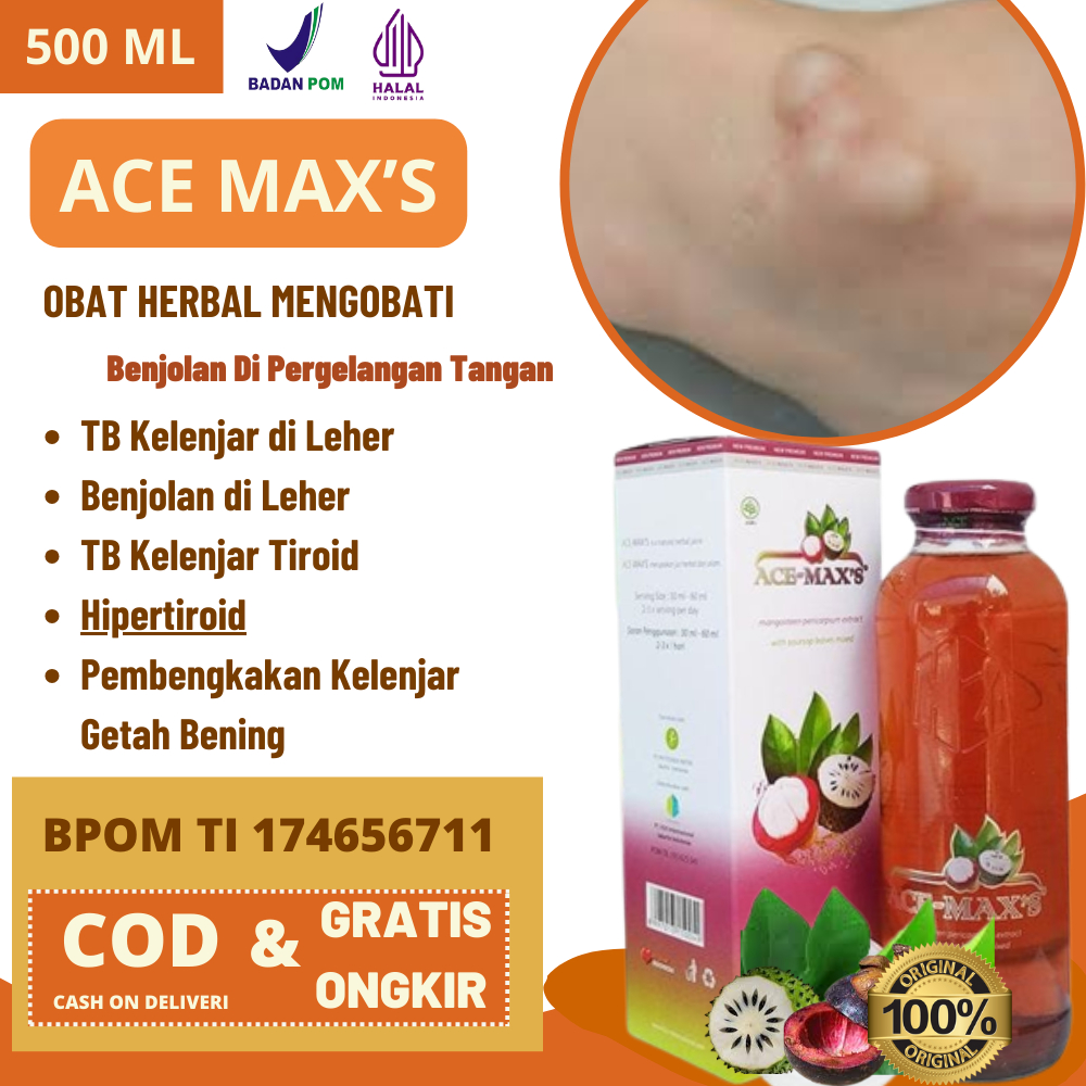 ACE MAXS Obat Benjolan Di Pergelangan Tangan, Kista Ganglion