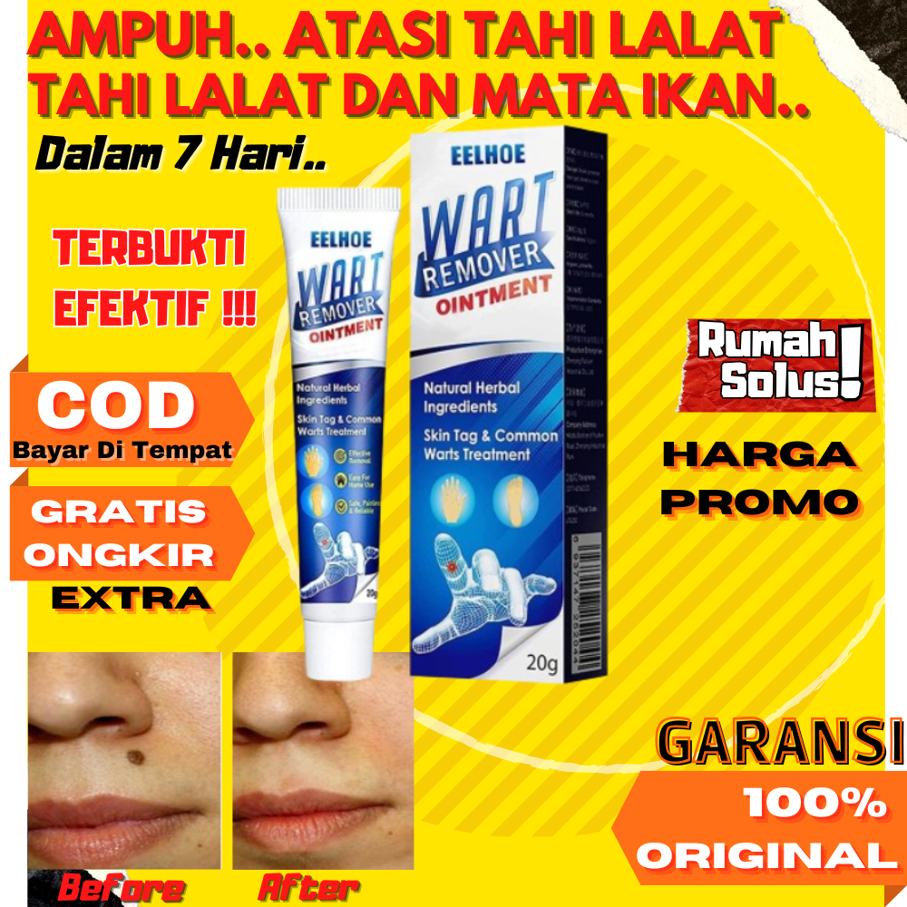 sumifun wart remover Eelhoe Wart Remover 100% Original - Penghilang Kutil Tahi Tai Lalat Mata Ikan A