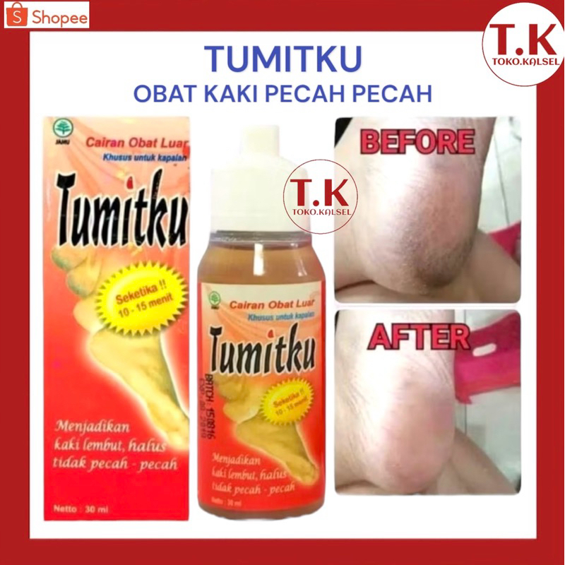 TUMITKU Obat Tumit Kaki Pecah Pecah Kapalan Tumitku