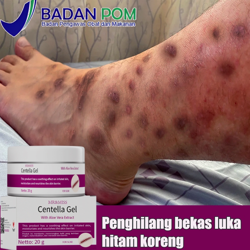 Penghilang bekas luka hitam koreng Penghilang bekas luka Penghilang bekas luka anak Salep penghilang