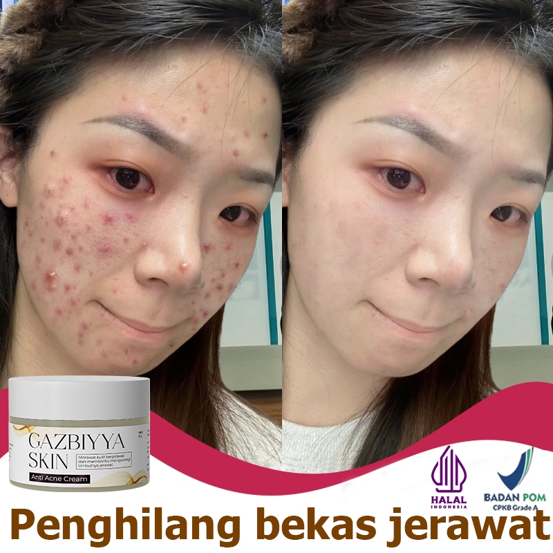 Obat totol jerawat obat jerawat penghilang bekas jerawat penghilang jerawat 30g Obat jerawat paling 