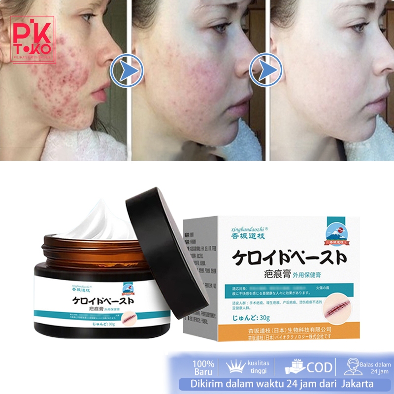 Cream Penghilang Bekas Luka Hilangkan Bekas Luka Korengan Krim Menghilangkan Bekas Luka Pehilang Bek