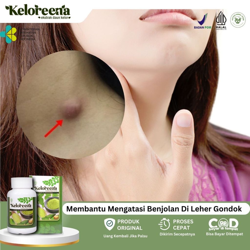 Obat Benjolan Di Leher, Obat Lipoma, Obat Uci uci, Obat Benjolan Payudara, Obat Kelenjar Getah Benin