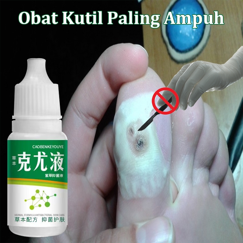 obat mata ikan obat kutil paling ampuh obat penghilang tahi lalat 10ml penghilang kutil dan tahi lal