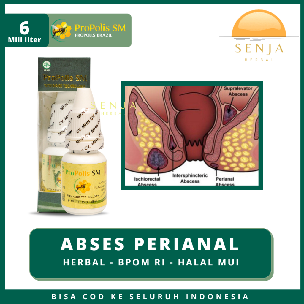 Propolis Brazil SM Tuntaskan Masalah Fistula Ani, Abses Perianal, Wasir, Ambeien