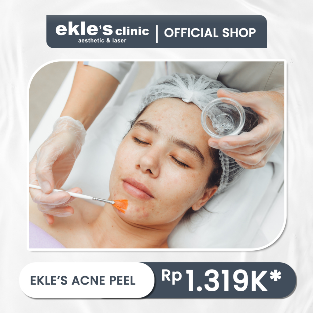 EKLES Acne Peel Treatment