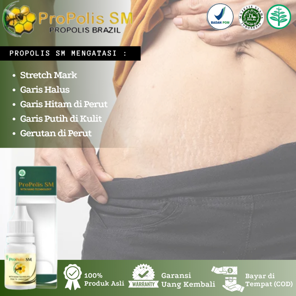 Propolis SM - Obat Penghilang Stretch Mark, Stretch Mark Di Perut, Garis Hitam / Putih Di Kulit, Sal