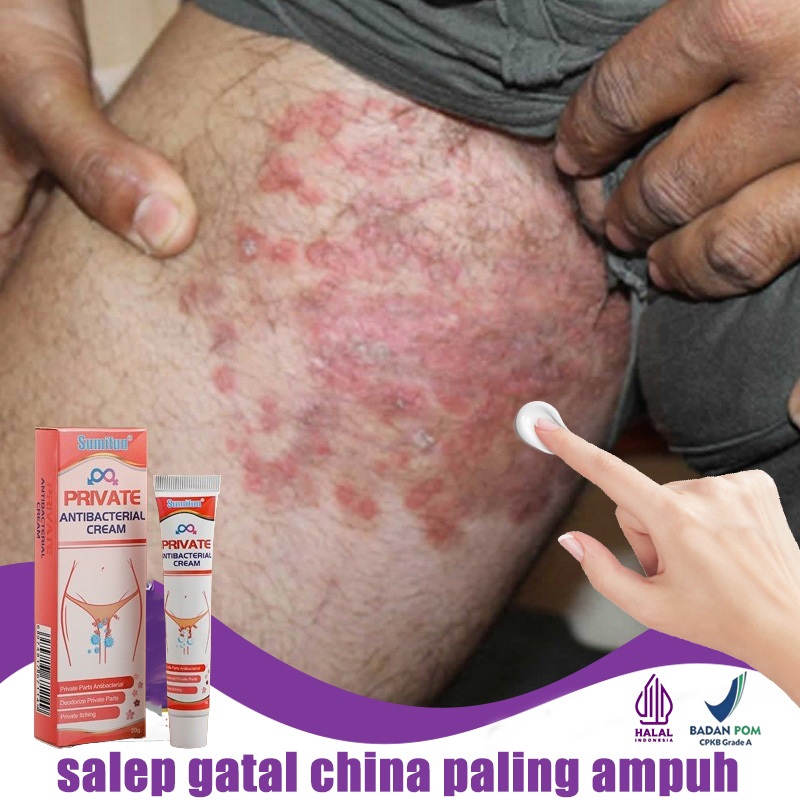 Salep gatal paling ampuh Obat gatal selangkangan salep gatal kulit yang ampuh 30g Salep gatal selang