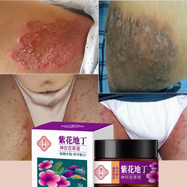 Obral Berkualitas COD1 AsliSalep gatal paling ampuh Obat gatal kulit Obat gatal selangkangan Obat ga