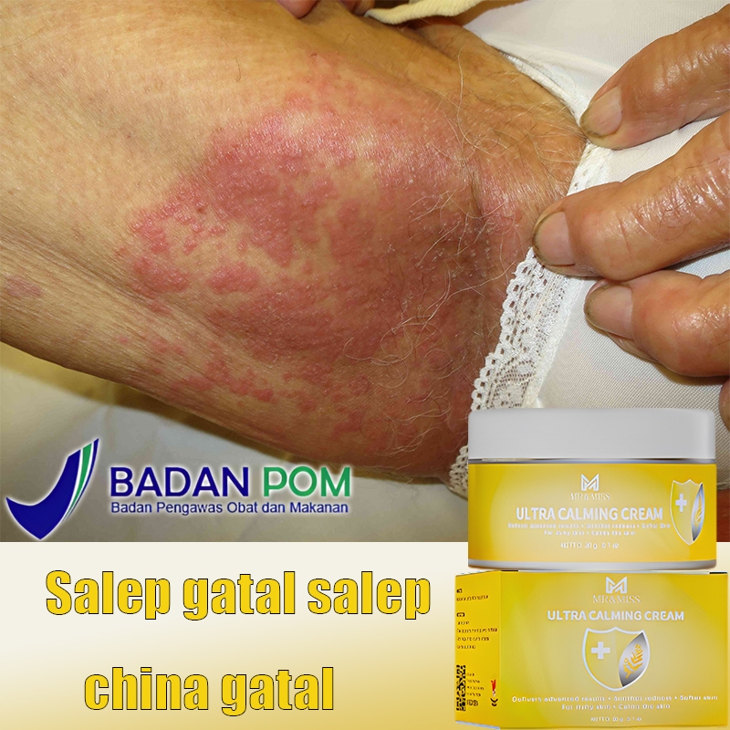 Obat gatal selangkangan Obat gatal gatal Salap gatal kulit yang ampuh Salep gatal selangkangan 20g o